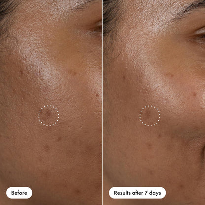 Hero_Cosmetics_Dark_Spot_Correct_Spot-Fading_15%_Vitamin_C_plus_Hyaluronic_Acid_Serum._Improves_the_Look_of_Post_Blemish_Marks_in_7_Days._Twist_Applicator_and_Rollerball_Tip_for_Easy_Application._10mL