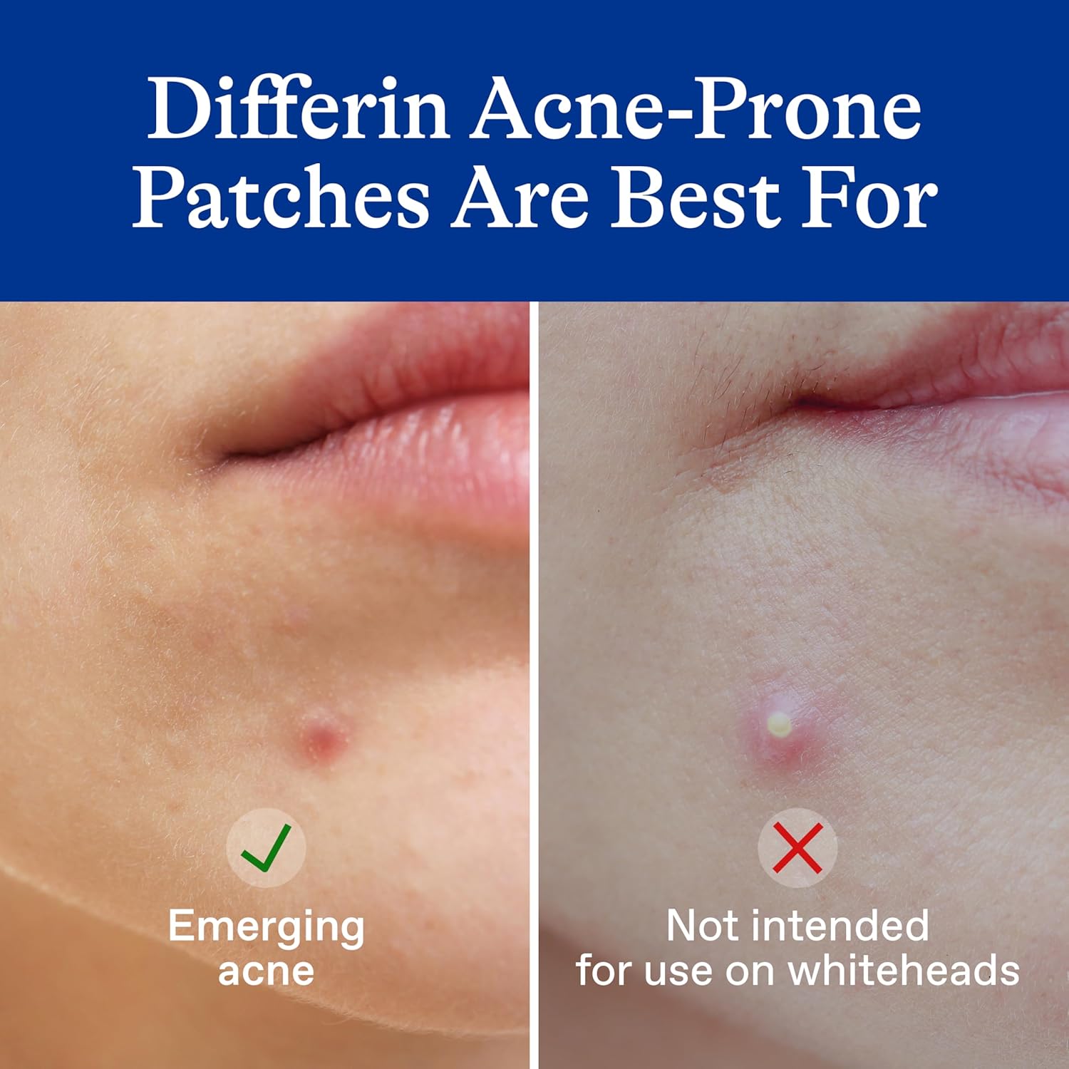 Differin_Acne_Patches,_Pimple_Patches_for_Acne_Prone_Skin,_Formulated_with_Salicylic_Acid_and_Centella,_Fast_Triple_Action_Power_Patch_for_Day_&_Night,_Dermatologist_Tested,_36_Count