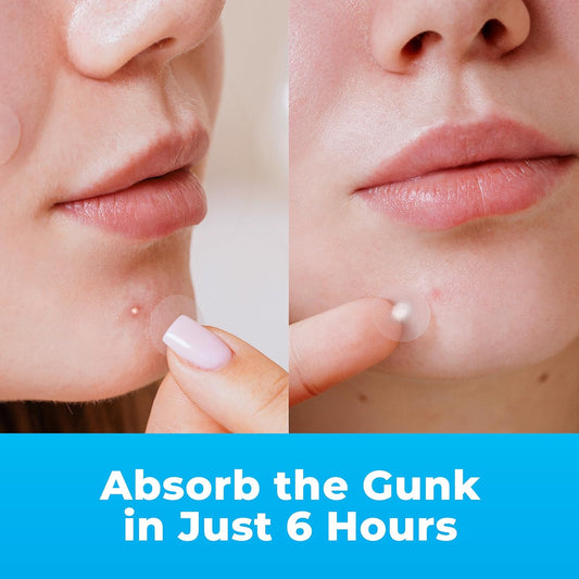 PatchRx_Pimple_Patches_for_Face_(120_Patches),_Hydrocolloid_Acne_Patches_with_Tea_Tree_Oil,_Pimple_Patch_Pimple_Stickers_-_Hydrocolloid_Patch_Acne_Dots_-_Acne_Pimple_Patches_For_Face_-_Zit_Patches