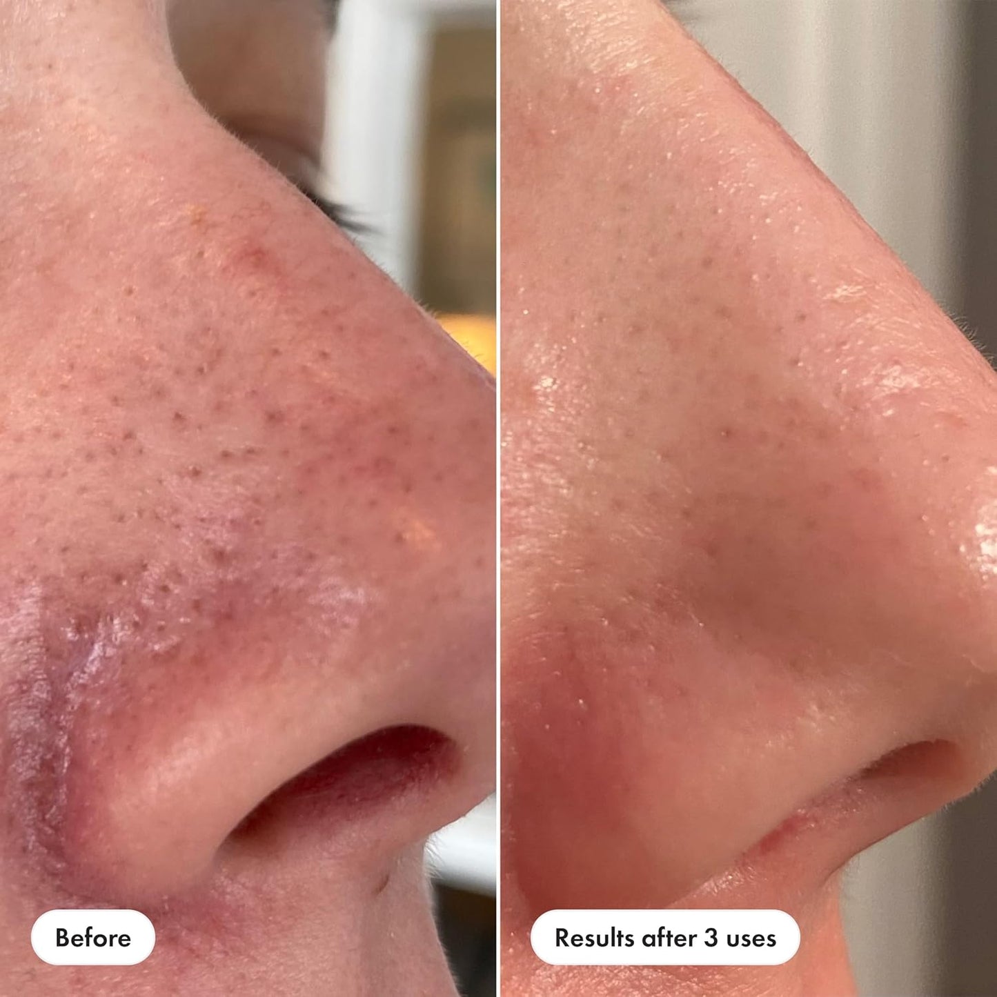 Hero_Cosmetics_Pore_Release_Blackhead_Clearing_Solution,_Exfoliating_2%_Salicylic_Acid_Toner_Featuring_AHA,_BHA,_and_PHA,_Blackhead_Remover_Toner,_100_ml