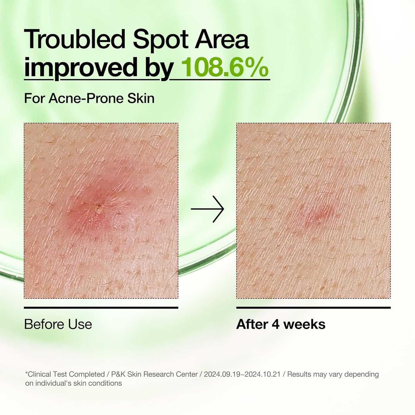 Anua_Azelaic_Acid_10_Hyaluron_Redness_Soothing_Serum,_Facial_Serum_for_Blemish-Prone_&_Oily-Prone_Skin,_Lightweight_&_Hydrating_Blemish_Care,_Hyaluronic_Acid,_Korean_Skincare,_1.01_fl_oz.