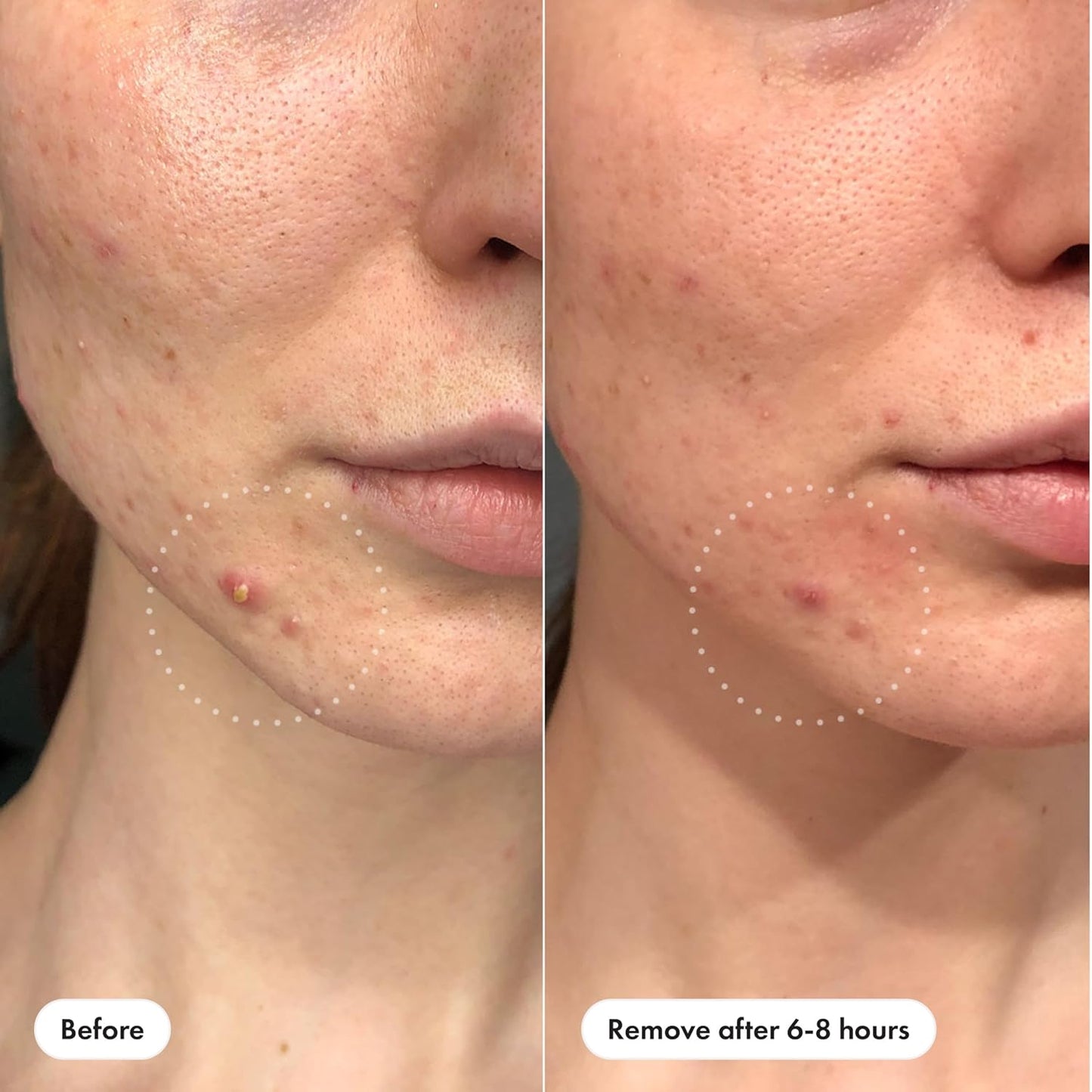 Mighty_Patch™_Invisible+_Patch_-_Daytime_Hydrocolloid_Acne_Pimple_Patches_for_Covering_Zits_and_Blemishes,_Ultra_Thin_Spot_Stickers_for_Face_and_Skin_(24_Medium_and_15_Small_Patches)