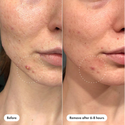 Mighty_Patch™_Invisible+_Patch_-_Daytime_Hydrocolloid_Acne_Pimple_Patches_for_Covering_Zits_and_Blemishes,_Ultra_Thin_Spot_Stickers_for_Face_and_Skin_(24_Medium_and_15_Small_Patches)