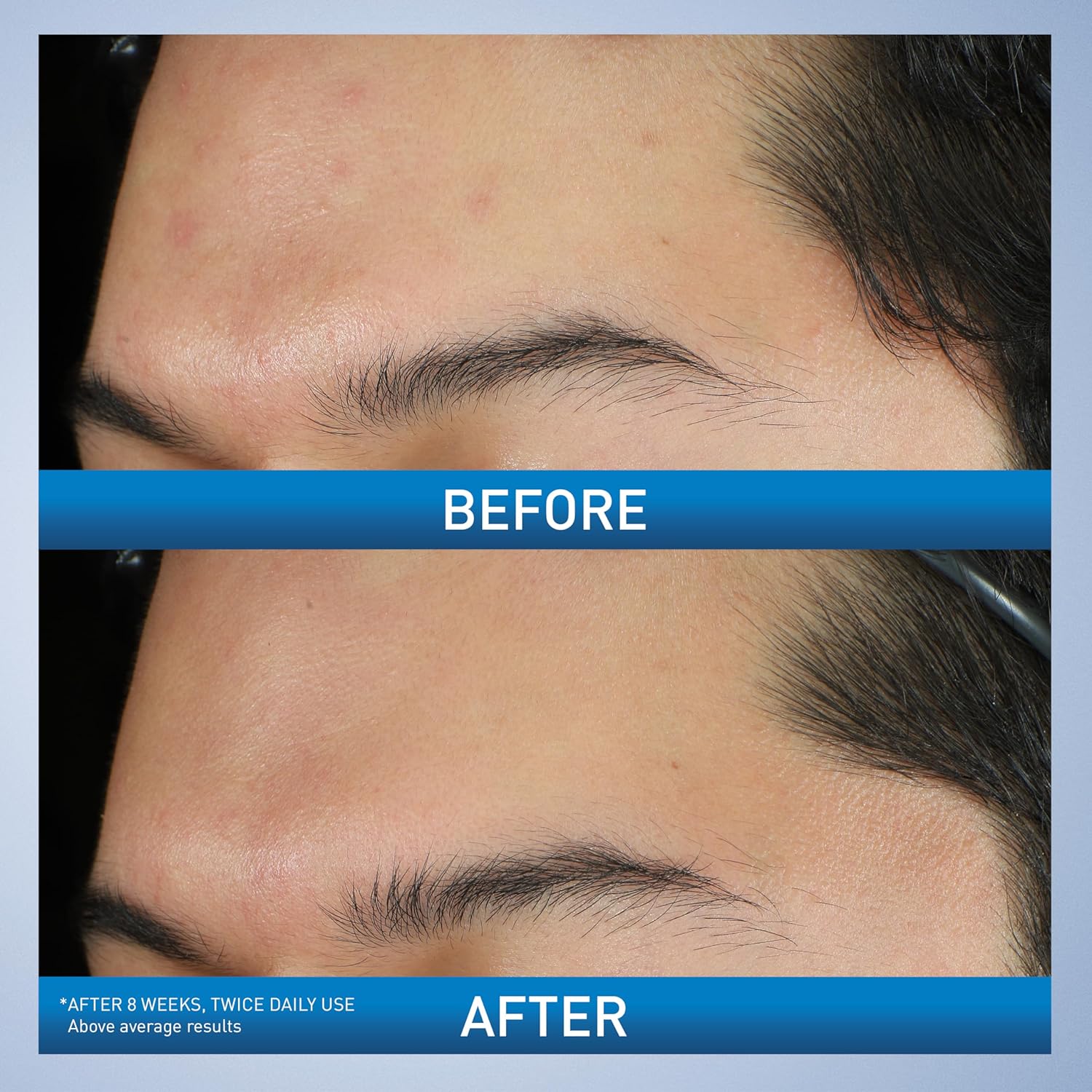 CeraVe_Acne_Foaming_Cream_Wash,_Gentle_Face_and_Body_Cleanser_with_Benzoyl_Peroxide_10%,_Hyaluronic_Acid,_and_Niacinamide,_10%_Benzoyl_Peroxide_Treatment_Clears_Pimples_and_Blackheads_5_Oz