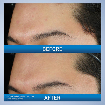 CeraVe_Acne_Foaming_Cream_Wash,_Gentle_Face_and_Body_Cleanser_with_Benzoyl_Peroxide_10%,_Hyaluronic_Acid,_and_Niacinamide,_10%_Benzoyl_Peroxide_Treatment_Clears_Pimples_and_Blackheads_5_Oz