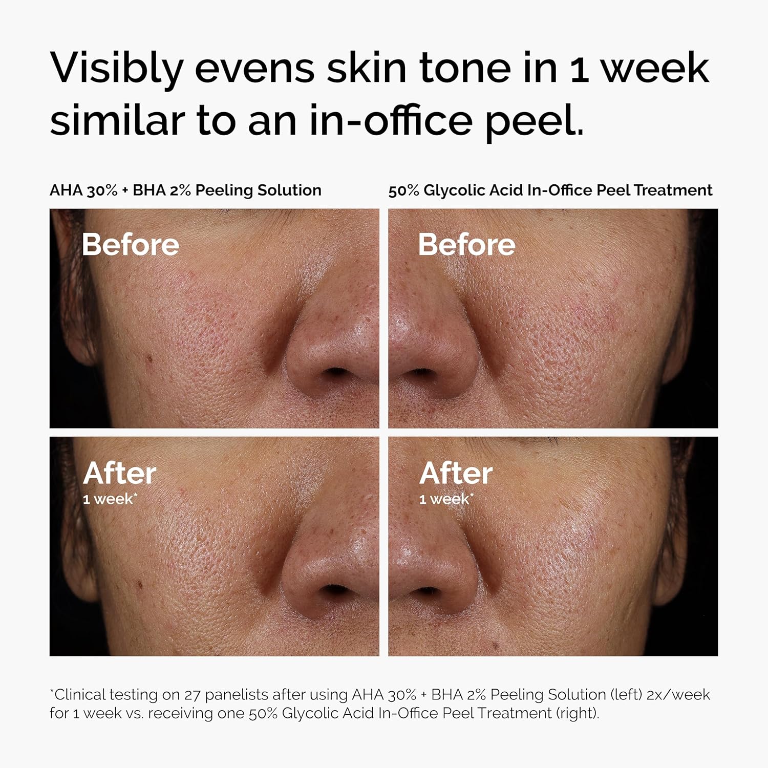 The_Ordinary_AHA_30%_+_BHA_2%_Peeling_Solution,_Advanced_Exfoliating_Peel_for_Brighter_Skin