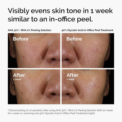 The_Ordinary_AHA_30%_+_BHA_2%_Peeling_Solution,_Advanced_Exfoliating_Peel_for_Brighter_Skin